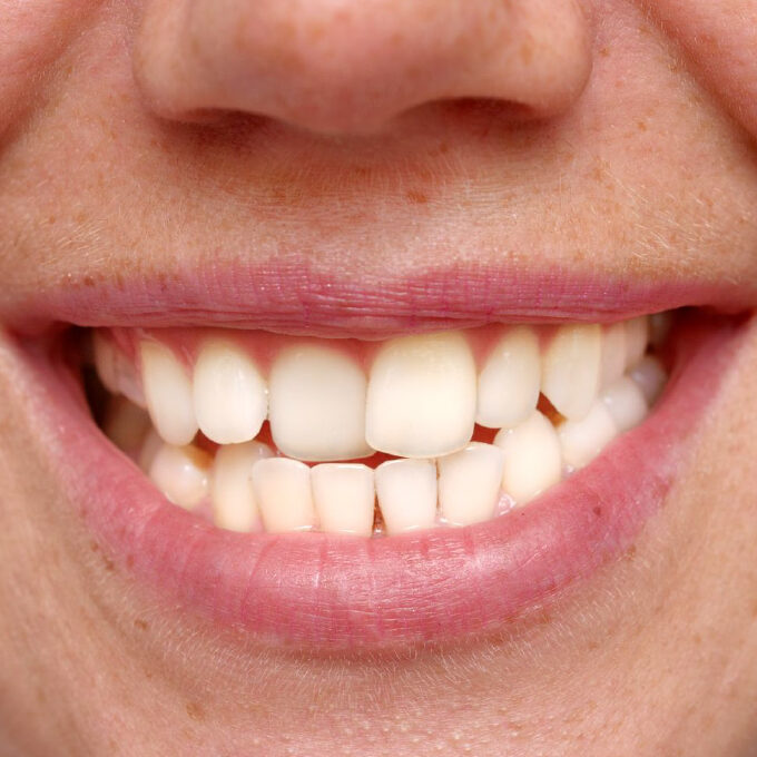 Crooked or misaligned teeth