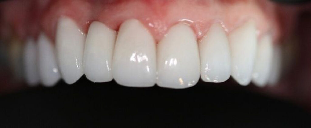 Teeth after dental implants