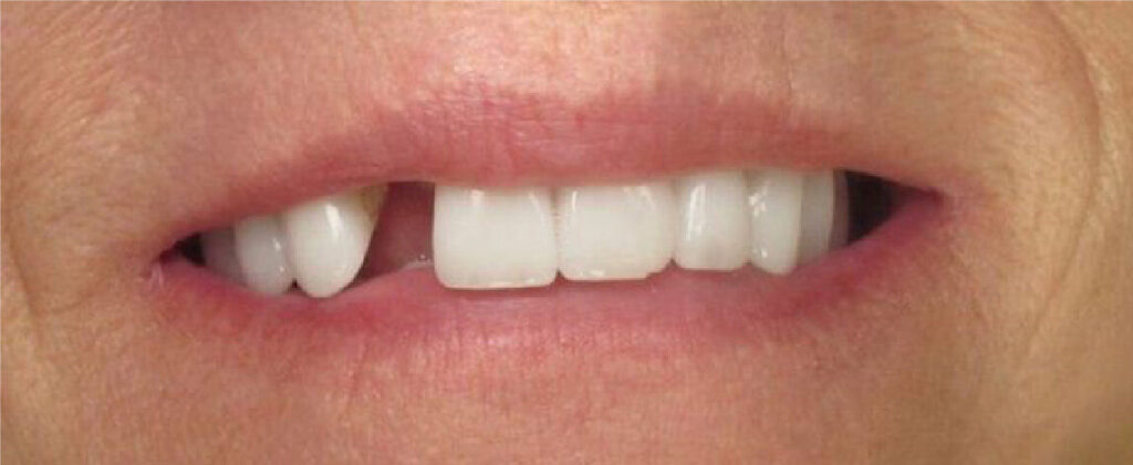 Teeth before dental implants