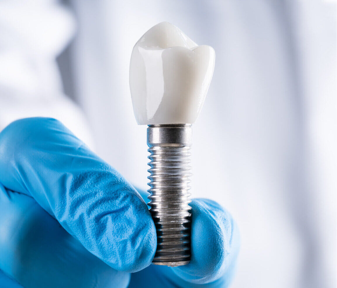 Example of a dental implant