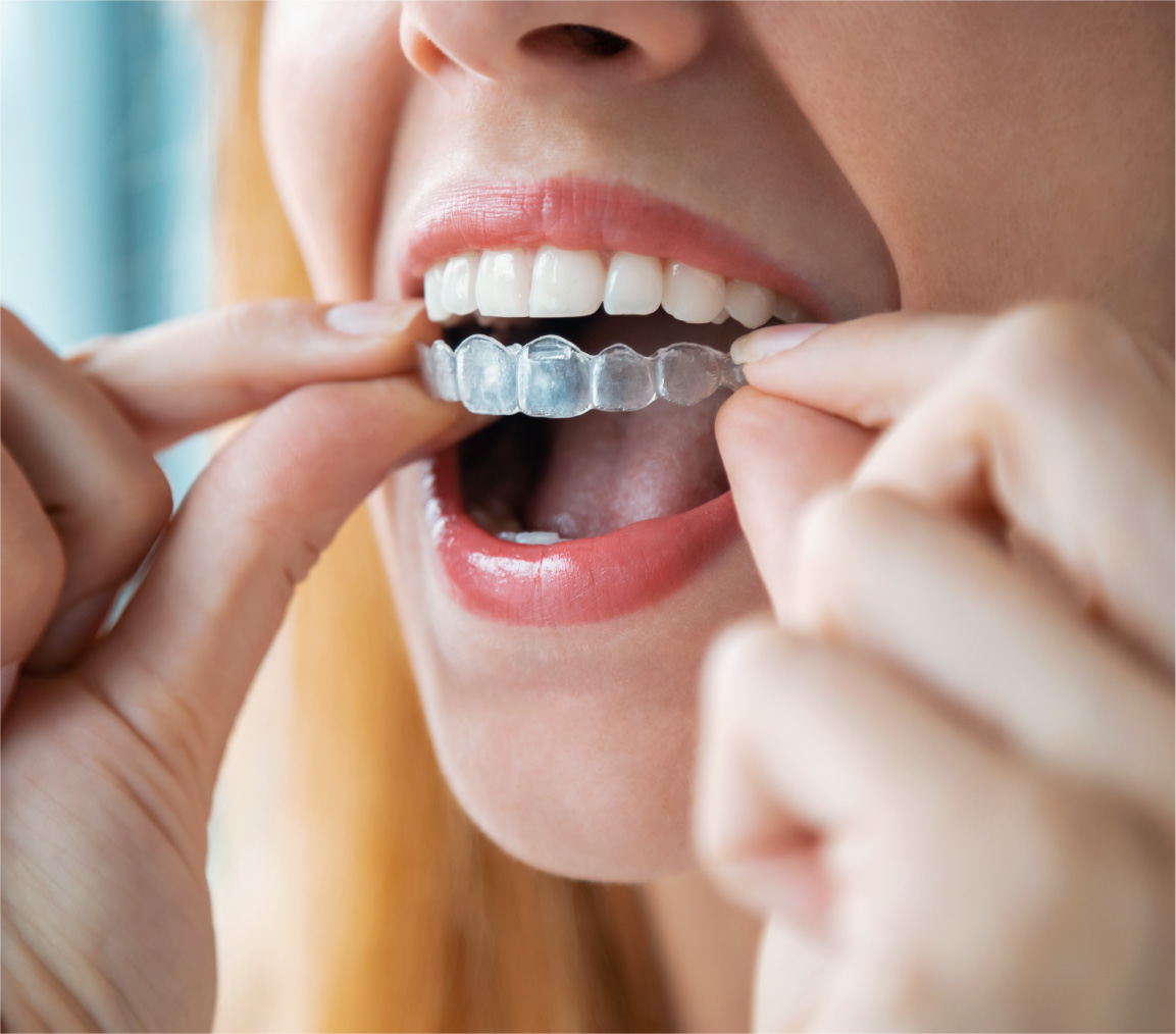 Woman putting in Invisalign® retainer