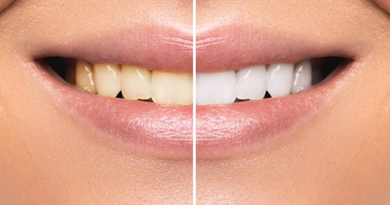 Close up of female mouth. Comparison after teeth whitening