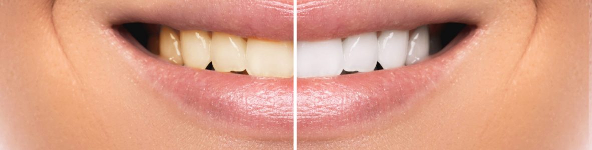 Close up of female mouth. Comparison after teeth whitening