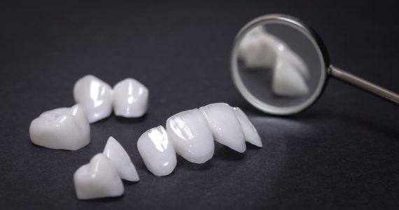 dental veneers