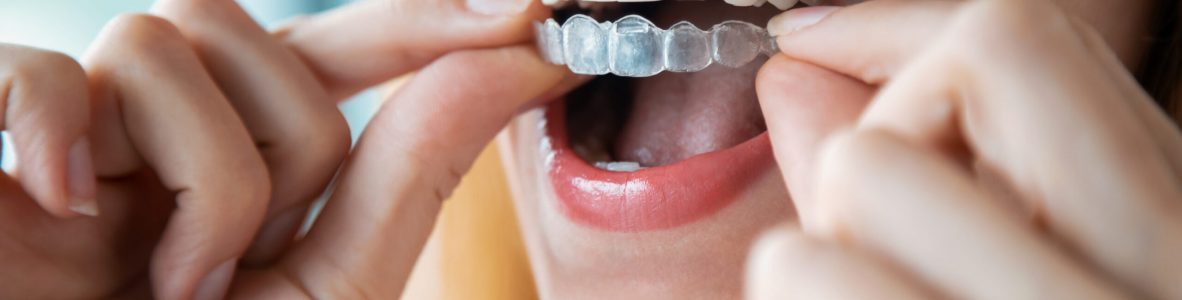 Close-up of woman wearing orthodontic silicone trainer. Invisible braces aligner.