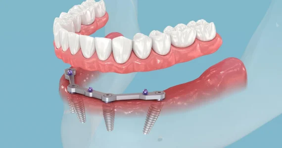 The-Mint-Dental-All-on-4+Implants