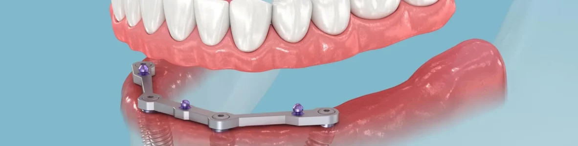 The-Mint-Dental-All-on-4+Implants The-Mint-Dental-All-on-4+Implants